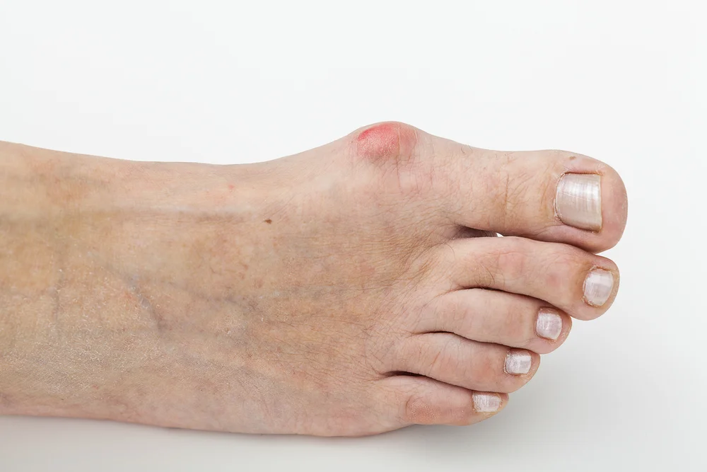 Shoes for best sale bunions hammer toes